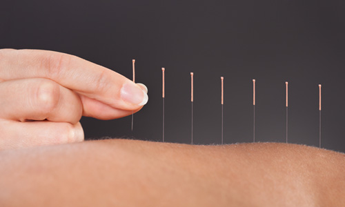 Acupuncture back pain success determined by psychological factors