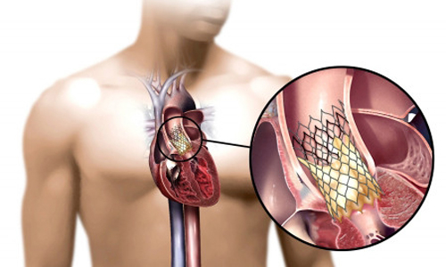 Implanted heart valve safe for low-risk patients