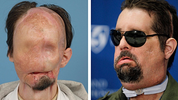 Should we keep doing face transplants?