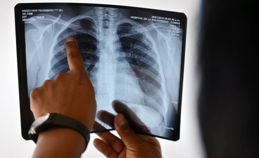 Tuberculosis deaths fall in Europe