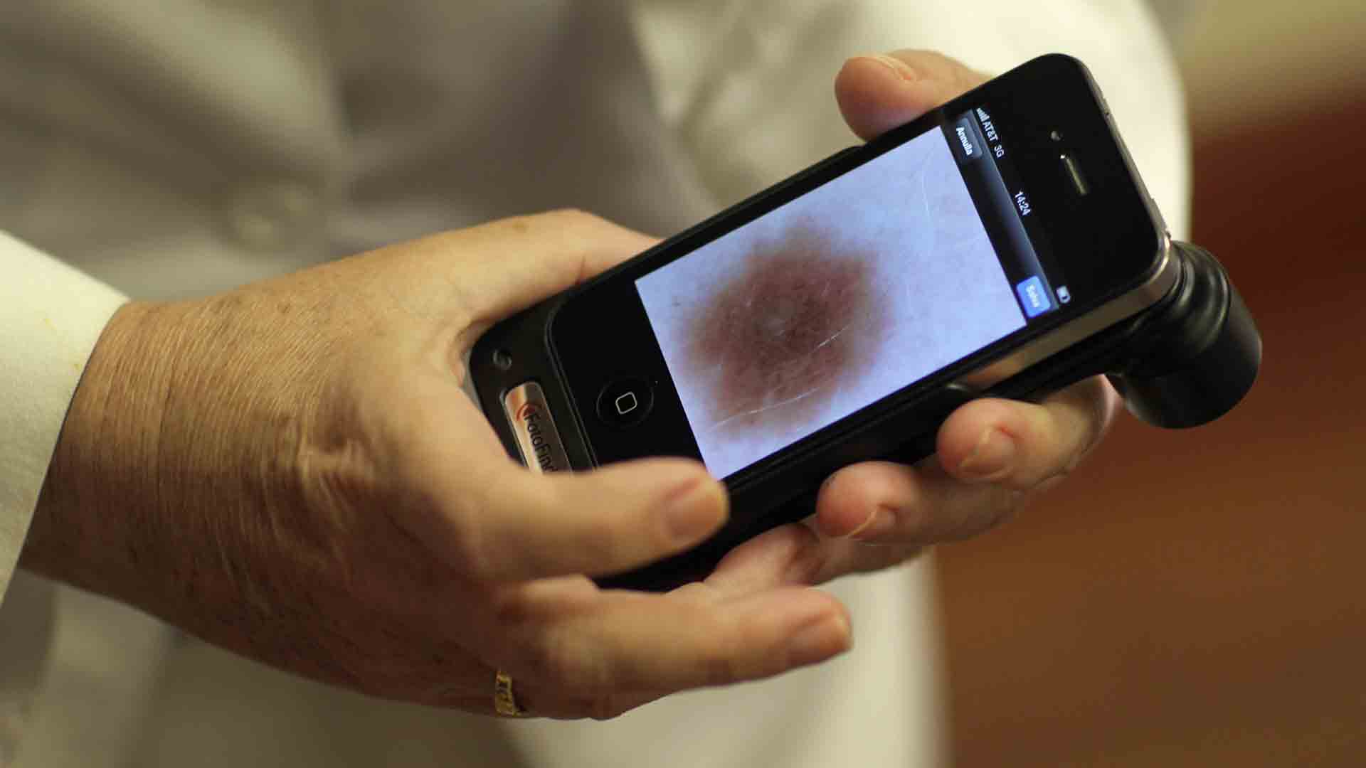 Smartphone pics may be sharp enough for dermatology diagnosis