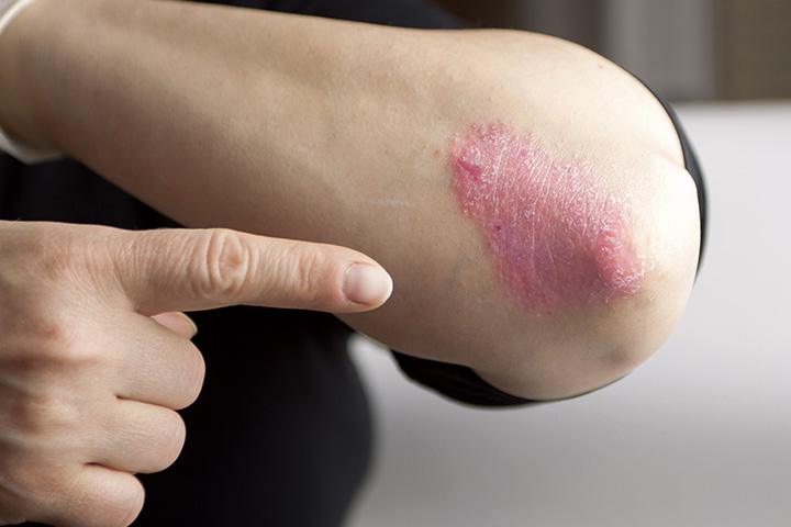 Teens with eczema may not follow prescribed treatment regimen