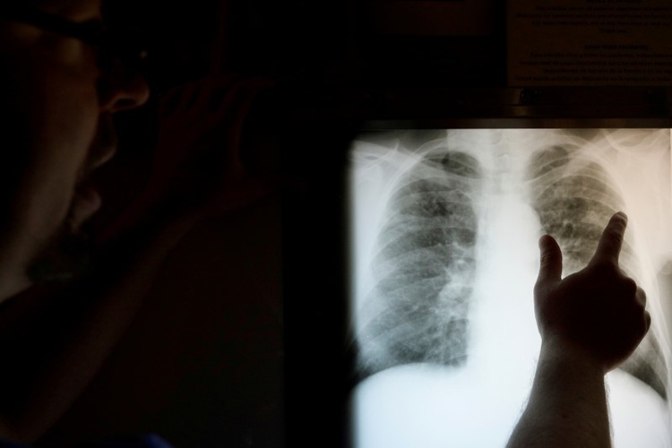 A tenth of US veteran coal miners have black lung disease: NIOSH