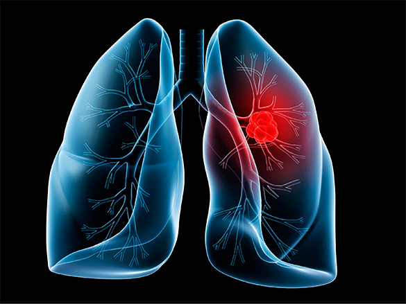 Doctors may not explain pros, cons of lung cancer screening