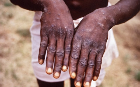 Britain reports two separate cases of rare monkeypox infection